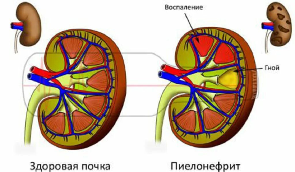 Здоровая почка и пиелонефрит.