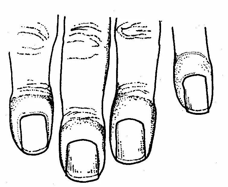 Пальцы стали толще. Барабанные палочки пальцы Гиппократа. Барабанные палочки ногти Гиппократа. Барабанные палочки — утолщение концевых фаланг. Колбовидное утолщение концевых фаланг пальцев кистей.