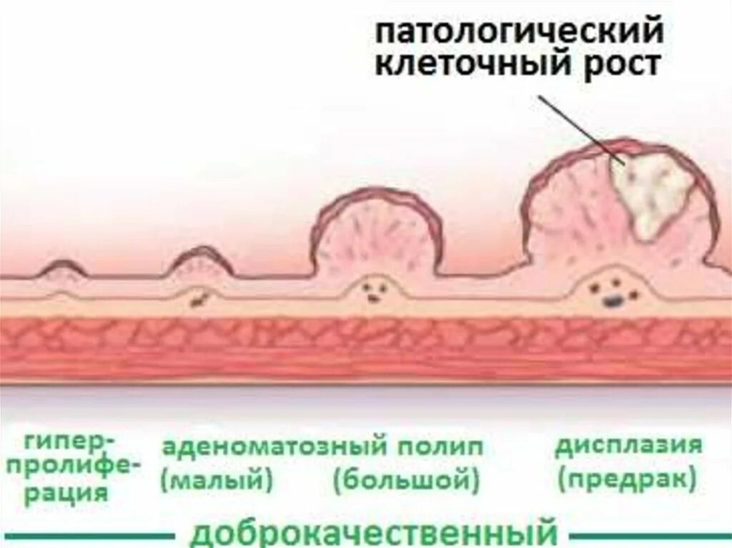 Полипы прямой кишки классификация. Малигнизация полипа прямой. Классификация полипов толстой кишки. Причины развития полипов. Эпителиальное образование желудка что это