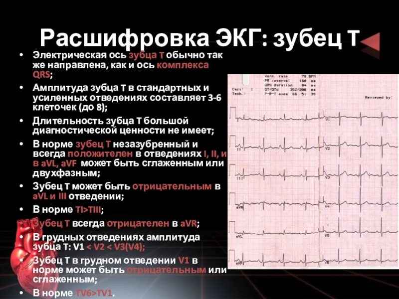 Расшифровка ЭКГ зубец t. Норма комплекса QRS на ЭКГ У взрослых. QRS норма ЭКГ. Ось QRS норма ЭКГ. Экг сочи