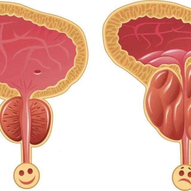 Простатита. Простатит рисунок.