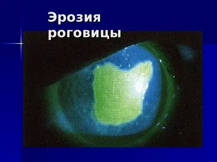 Мкб роговица