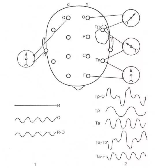 Ээг 10 10. ЭЭГ монополярные отведения. Биполярное отведение в ЭЭГ это. Схема расположения электродов при ЭЭГ 10-20. Схема ЭЭГ 10-20.