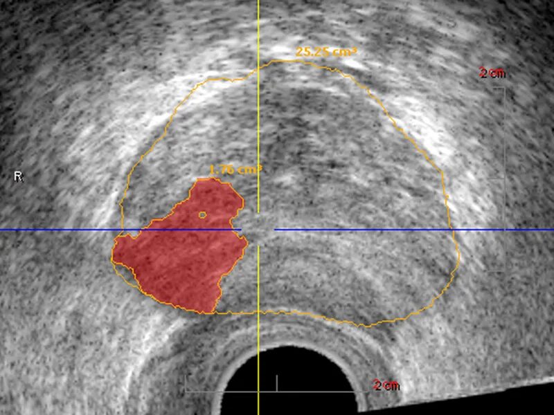 Подозрения на простату. Хронический бактериальный простатит. Гистосканирование предстательной железы. Бактериальный простатит на УЗИ. Хронический простатит фото.