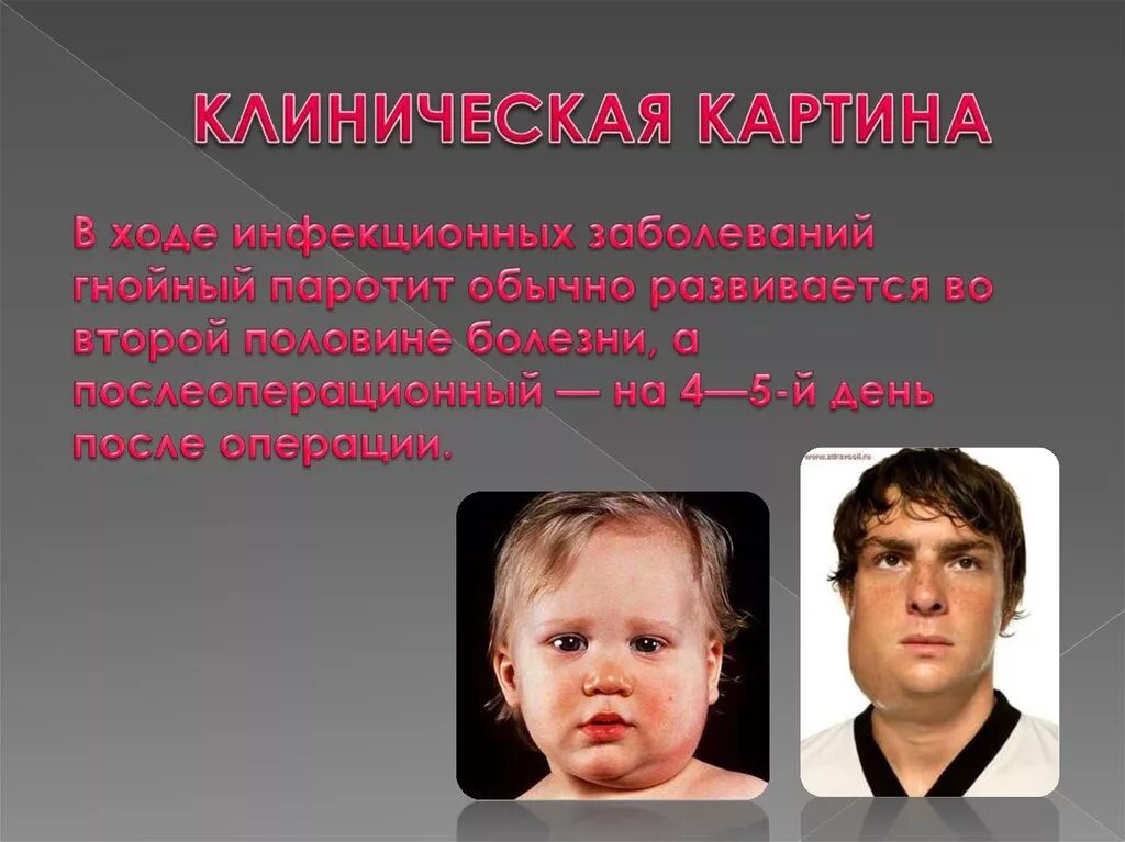 ЧТО ТАКОЕ ЭПИДЕМИЧЕСКИЙ ПАРОТИТ? - Городские новости - Новости - Официальный сай