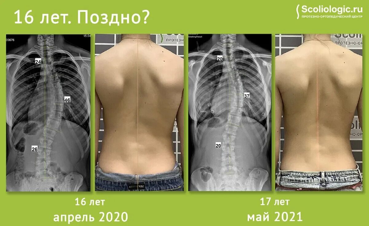 Корсет для сколиоза. Сколиоз корсет Шено. Корсет Шено при сколиозе. Корсет шрот. Сколиоз 2 степени это