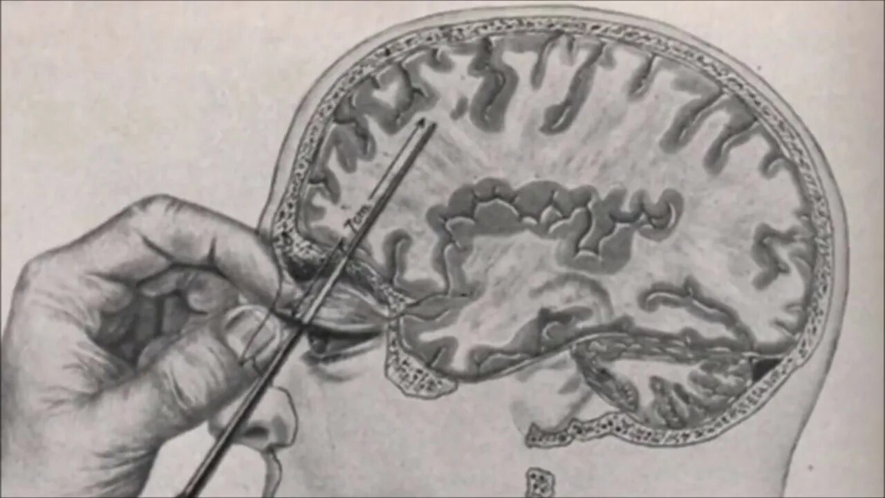 Префронта́льная Лоботоми́я. Лоботомия сейчас делают