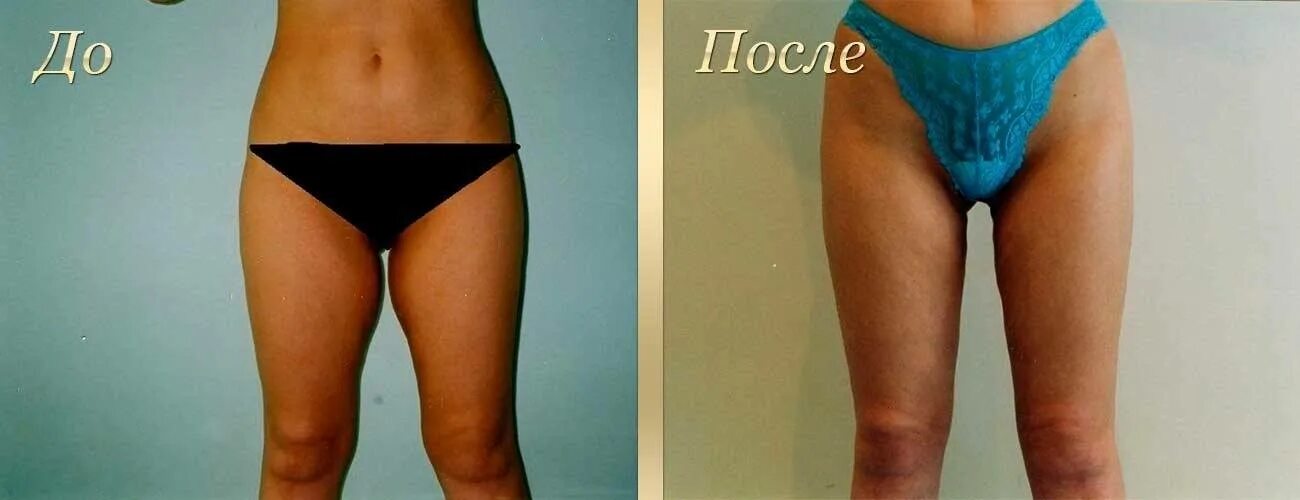как подтянуть кожу на бедрах. пластика внутренней поверхности бедер. липомоделирование бедер и ягодиц. как подтянуть кожу на бедрах. внутренняя поверхность бедра.