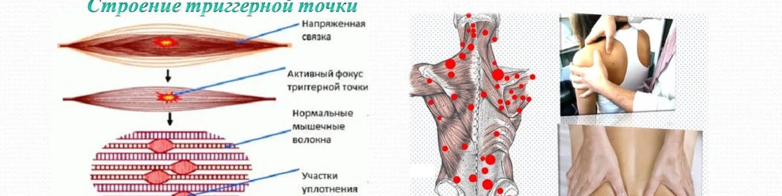 Триггерные точки грудного отдела спереди. Миофасциальный триггерные точки. Миофасциальные триггерные точки спины. Миофасциальный синдром триггерные точки спины. Триггерные точки это простыми словами