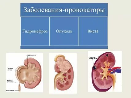 Тесты гидронефроз по утвержденным клиническим рекомендациям 2023