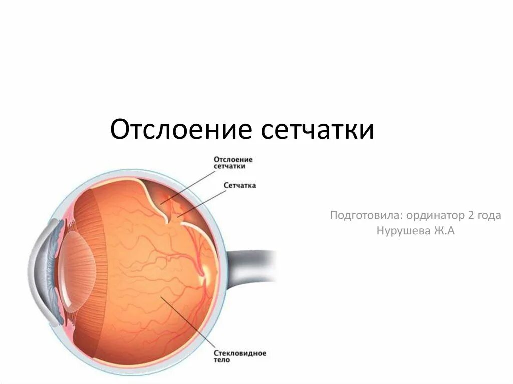 Вторичная отслойка сетчатки глаза. Верхняя отслойка сетчатки. Отслоение сетчатки операция. Отслоение сетчатки симптомы.