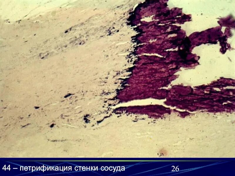 Атеросклероз аорты препарат. Петрификация атеросклероз бляшки. петрификация стенки сосуда. атеросклероз аорты микропрепарат.