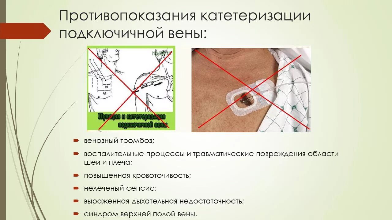 Уход за подключичным катетером. Катетеризация подключичной вены. Подключичный катетер постановка. Пункция и катетеризация подключичной вены. Точки постановки подключичного катетера.