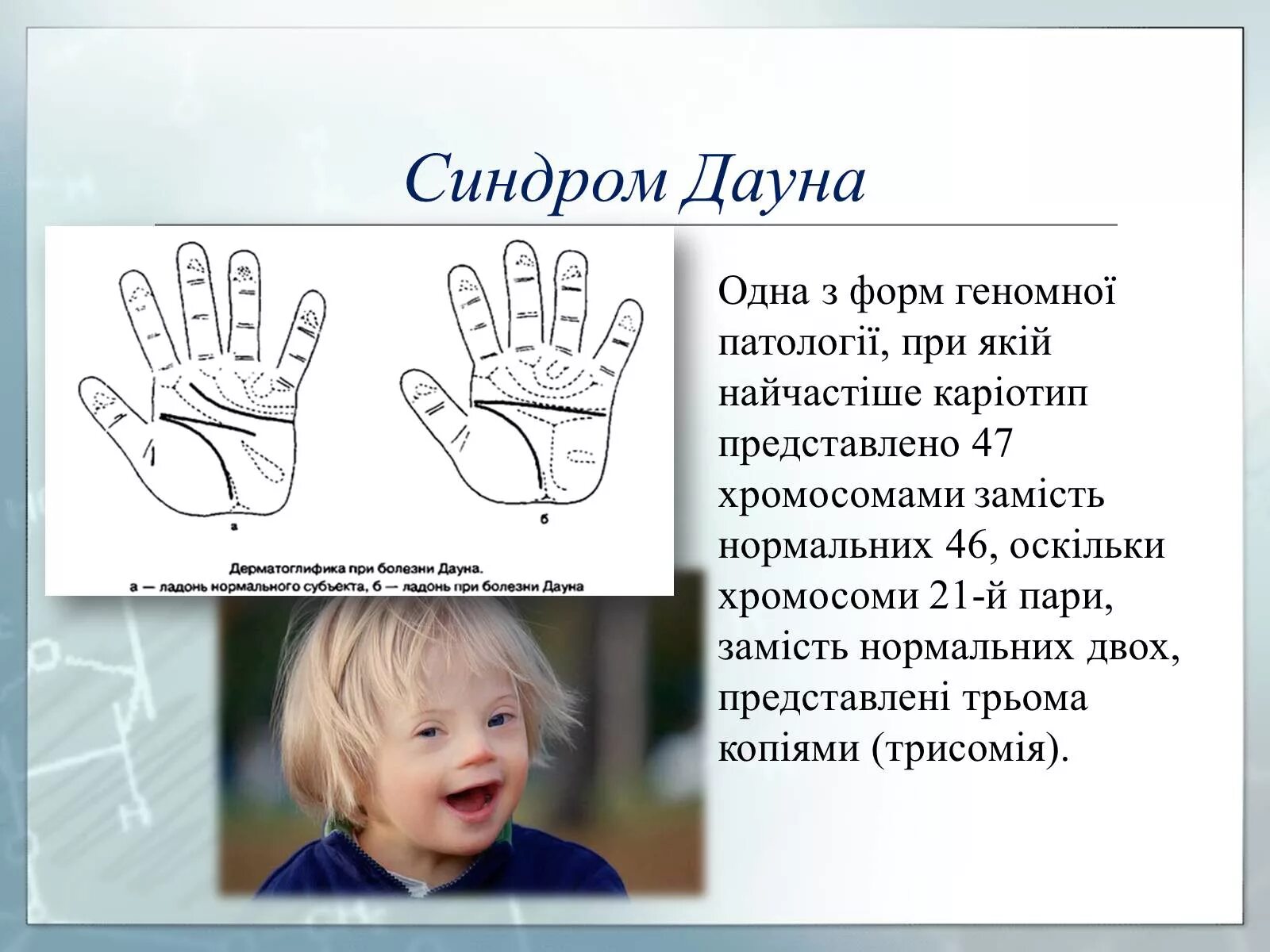 План дауна. Ладони детей с синдромом Дауна. Дерматоглифика синдрома Дауна. Ладонь при синдроме Дауна.