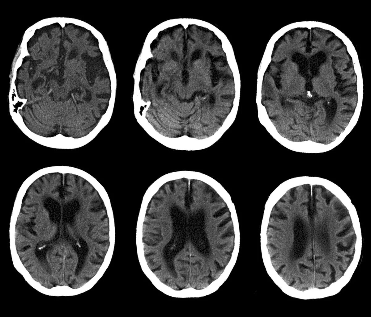 Brain disease. Кт и мрт при болезни Альцгеймера. Болезнь Альцгеймера на кт. Магнитно резонансная томография головного мозга энцефалопатия. Болезнь Альцгеймера снимок кт.