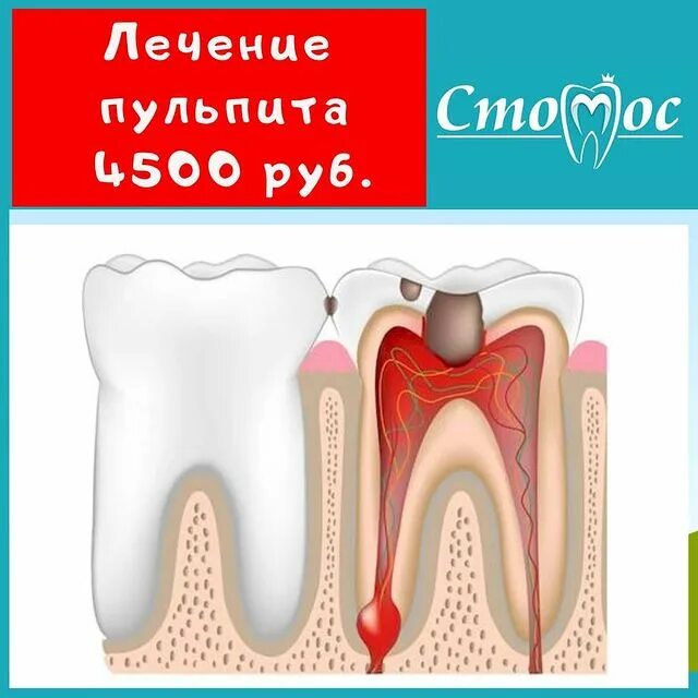 Пульпит корневого канала. Периодонтит и пульпит разница. Хронический периодонтит. Пульпит медикаментозная обработка корневых каналов. Как удаляют пульпит.