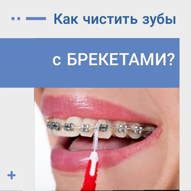 Как чистить зубы в брекетах. Как чистить зубы с брекетами.