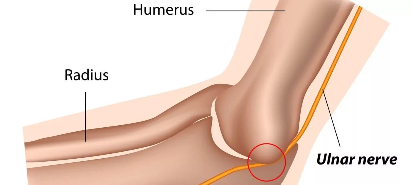 Вывих нерва локтевого сустава. Кубитальный тоннель локтевого нерва.