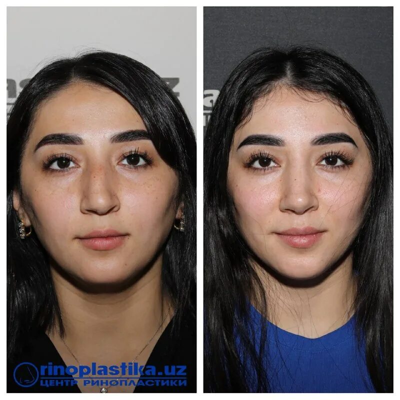 центр ринопластики. медиэстетик ринопластика. константин матвеев ринопластика. центр ринопластики. центр ринопластики.
