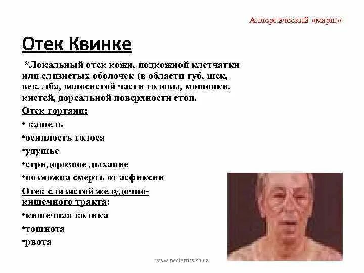 Отек квинке синдромы. Клинические проявления отека квинке. отек квинке отек гортани.