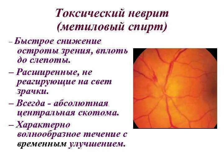 Ретробульбарный неврит симптомы. Токсический неврит этиология. • снижение остроты зрения вплоть до слепоты. токсические амблиопия метиловым спиртом. метиловый спирт снижение зрения.