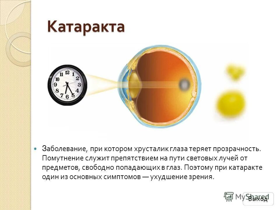 Точка лежащая зрение. Катаракта схема глаза. Нормальное зрение. Нормальное зрение у человека. Нормальное зрение и катаракта.