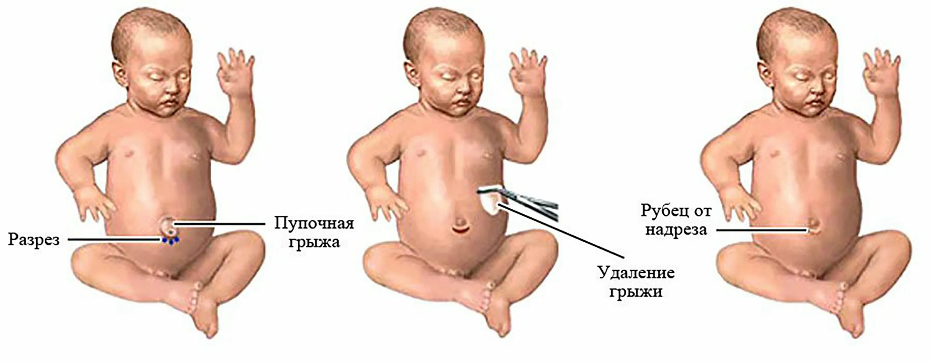 Пупочная грыжа что можно кушать. Пупочная грыжа у грудничка. Пупочная грыжа у детей до 1 года. Пупочная грыжа у детей до 7 лет. Пупочная грыжа у 6 месячного ребенка.