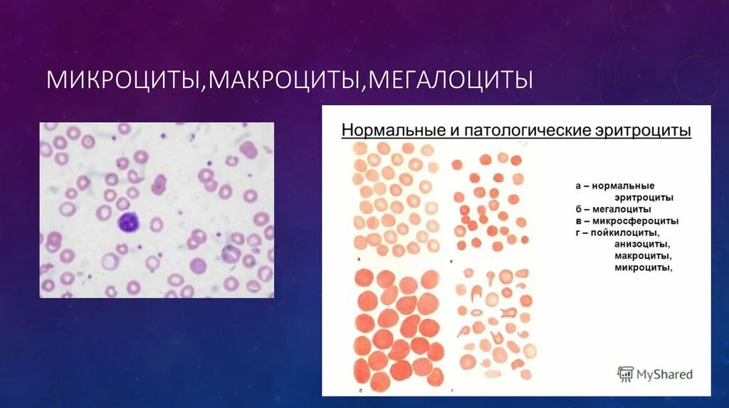 Микроциты повышены. Анизоцитоз макроцитоз мегалоциты мегалобласты. Макроциты и микроциты. Анизоцитоз микроциты. Нормоциты микроциты макроциты мегалоциты.