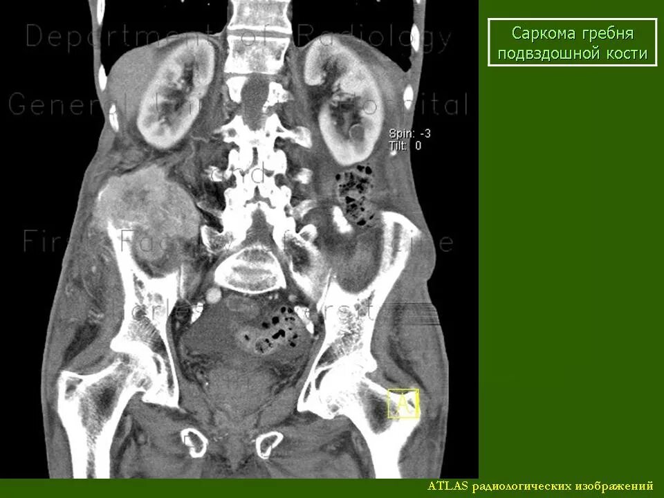 Кт подвздошной кости. Остеосаркома бедренной кости кт. Остеосаркома тазобедренного сустава кт. Хондросаркома подвздошной кости на кт. Саркома подвздошной кости кт.