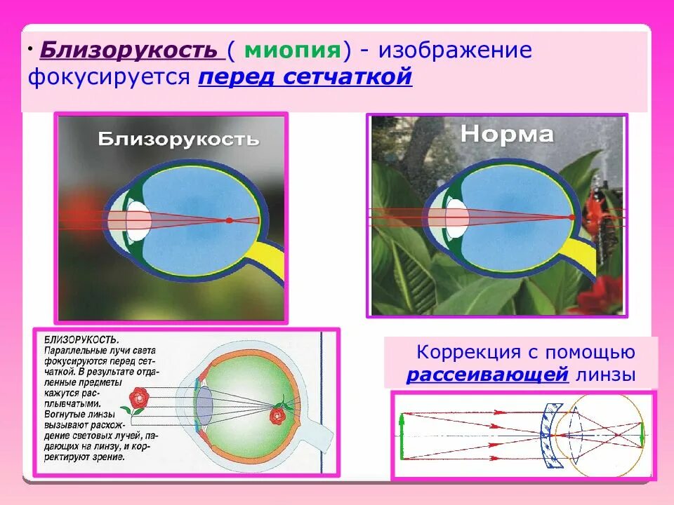 Дальнозоркость линзы двояковыпуклые. Близорукость. Близорукость миопия. Близорукость изображение фокусируется перед сетчаткой. Изображение предметов фокусирующихся перед сетчаткой это.