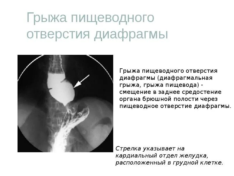 Гпод в гастроэнтерологии что. Диафрагмальная грыжа желудка рентген. грыжи пищеводного отверстия диафрагмы (гпод). степени грыжи пищеводного отверстия диафрагмы рентген. грыжа кардиального отдела пищевода.