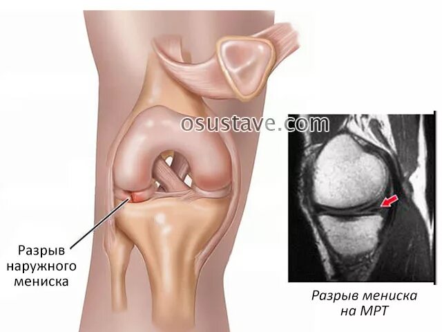 Надрыв мениска коленной чашечки. Разрыв мениска коленного симптомы. Разрыв мениска коленного сустава. Разрыв мениска коленного сустава симптомы. Повреждения мениска коленного сустава как лечить