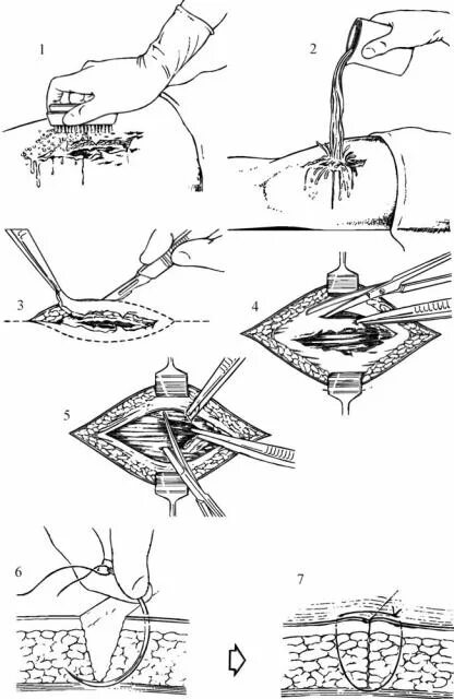 Дренирование гнойны ран. Пхо раны этапы операции. Хирургическая обработка раны методом частичного иссечения. Первичная хирургическая обработка гнойной раны.