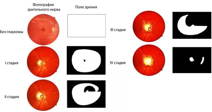 Стадии глаукомы. Стадии развития глаукомы. Классификация глаукомы по полям зрения. Атрофия зрительного нерва классификация. Классификация глаукомы