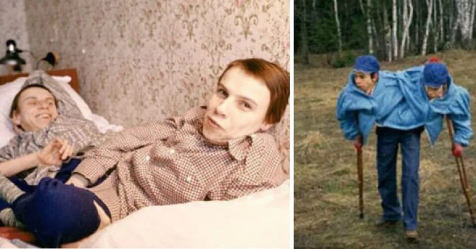 сиамские близнецы маша. сиамские близнецы маша. сёстры кривошляповы сиамские близнецы. сиамские близнецы маша. сёстры кривошляповы сиамские близнецы.