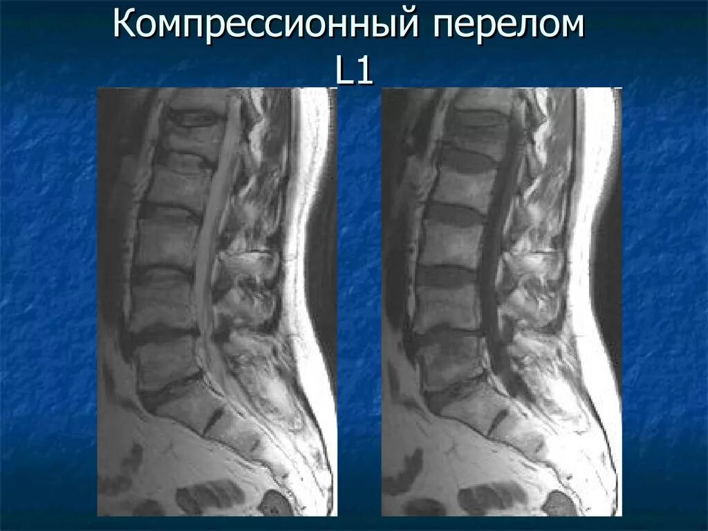 Компрессионный перелом позвоночника l1. Компрессионный перелом позвоночника l5. Компрессионный перелом позвоночника l1 поясничного отдела. Компрессионный перелом поясничного позвонка мрт.