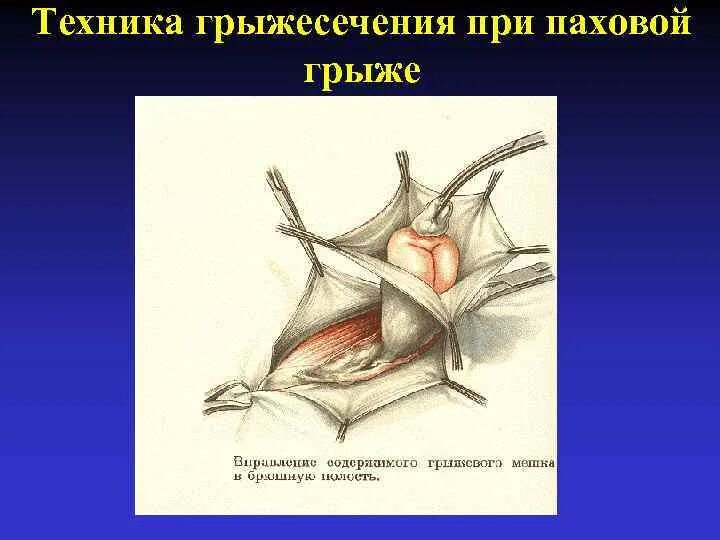 Грыжесечение вентральной грыжи этапы. Этапы грыжесечения паховой грыжи по Лихтенштейну. Грыжесечение при ущемленных грыжах. Грыжевой мешок при паховой грыже.