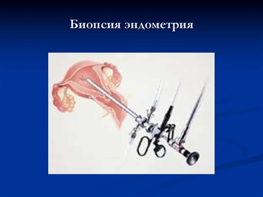 Анализ из полости матки. Вакуум-аспирация эндометрия. Пайпель-биопсия (аспирационная биопсия эндометрия). Вакуум аспирация шейки матки. Пайпель-биопсия эндометрия алгоритм.