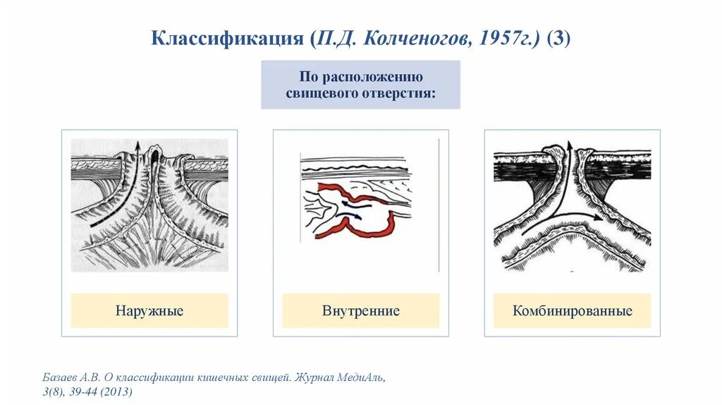 Перианальные свищи классификация. Наружные кишечные свищи классификация. Наружные кишечные свищи классификация. Виды свищей. Свищи (этиология, классификация).