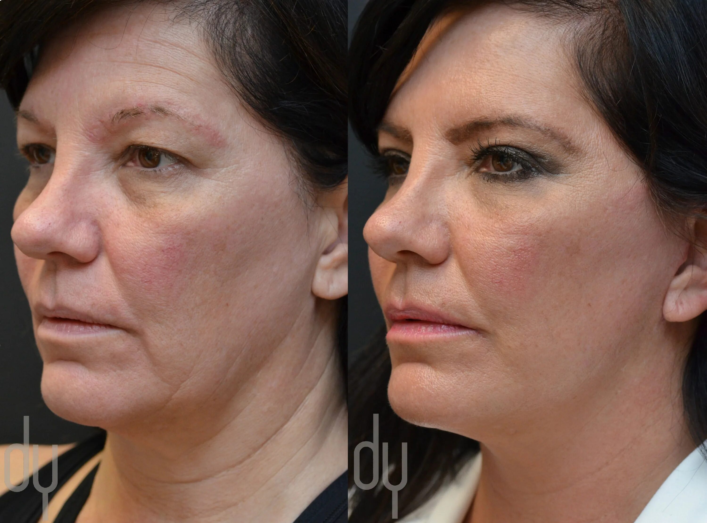 Deep lifting. Deep face lift.