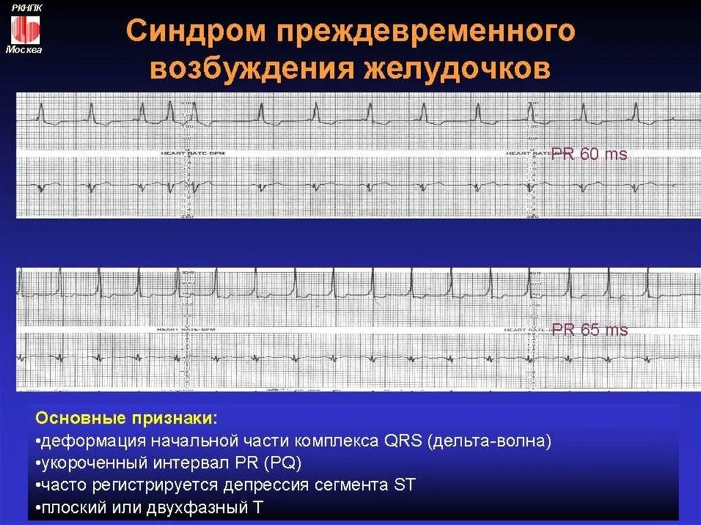 Синдром преждевременной. Синдром преждевременного возбуждения желудочков на экг. синдром преждевременного возбуждения. синдром водителя ритма. преждевременное возбуждение желудочков на экг.