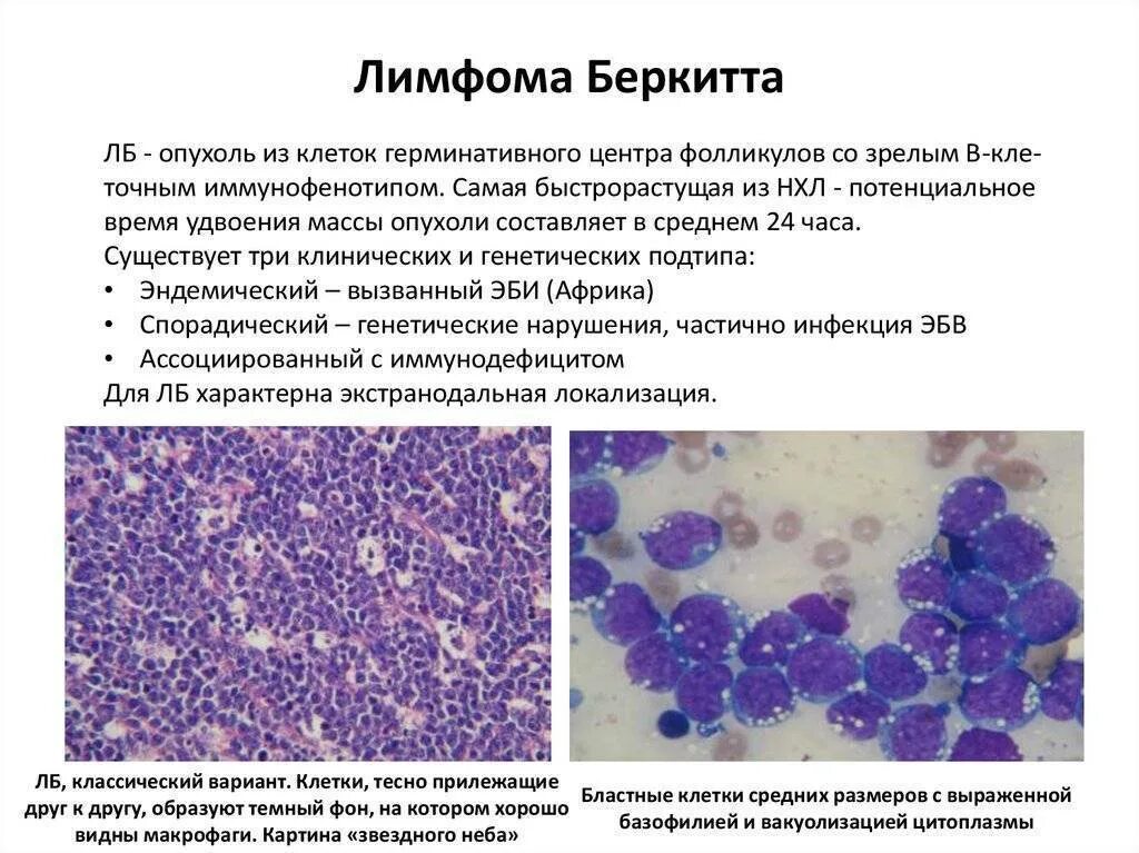 Причина лимфомы у взрослых. Неходжкинская лимфома гистология. Крупноклеточная лимфома гистология. Лимфома Беркитта гистология лимфоузла. Диагностические клетки лимфомы Ходжкина.