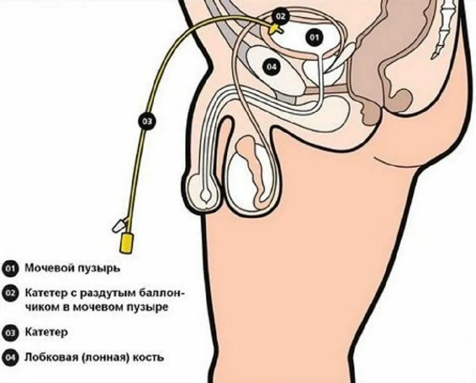 Как ставят катетер в мочевой пузырь. Схема катетера для мочевого пузыря. Надлобковый катетер Фолея. Эпицистостома катетер. Цистостома мочевого пузыря катетер.