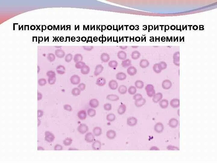 Гипохромия и микроцитоз эритроцитов. Гипохромия и микроцитоз эритроцитов. Микроцитоз эритроцитов. Микроцитоз эритроцитов. Микроцитоз эритроцитов.