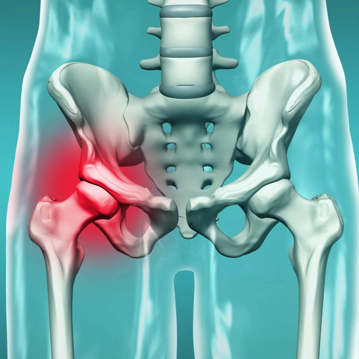 Люмбалгия тазобедренного сустава. Тазобедренный сустав Hip. Синостоз тазобедренного сустава.