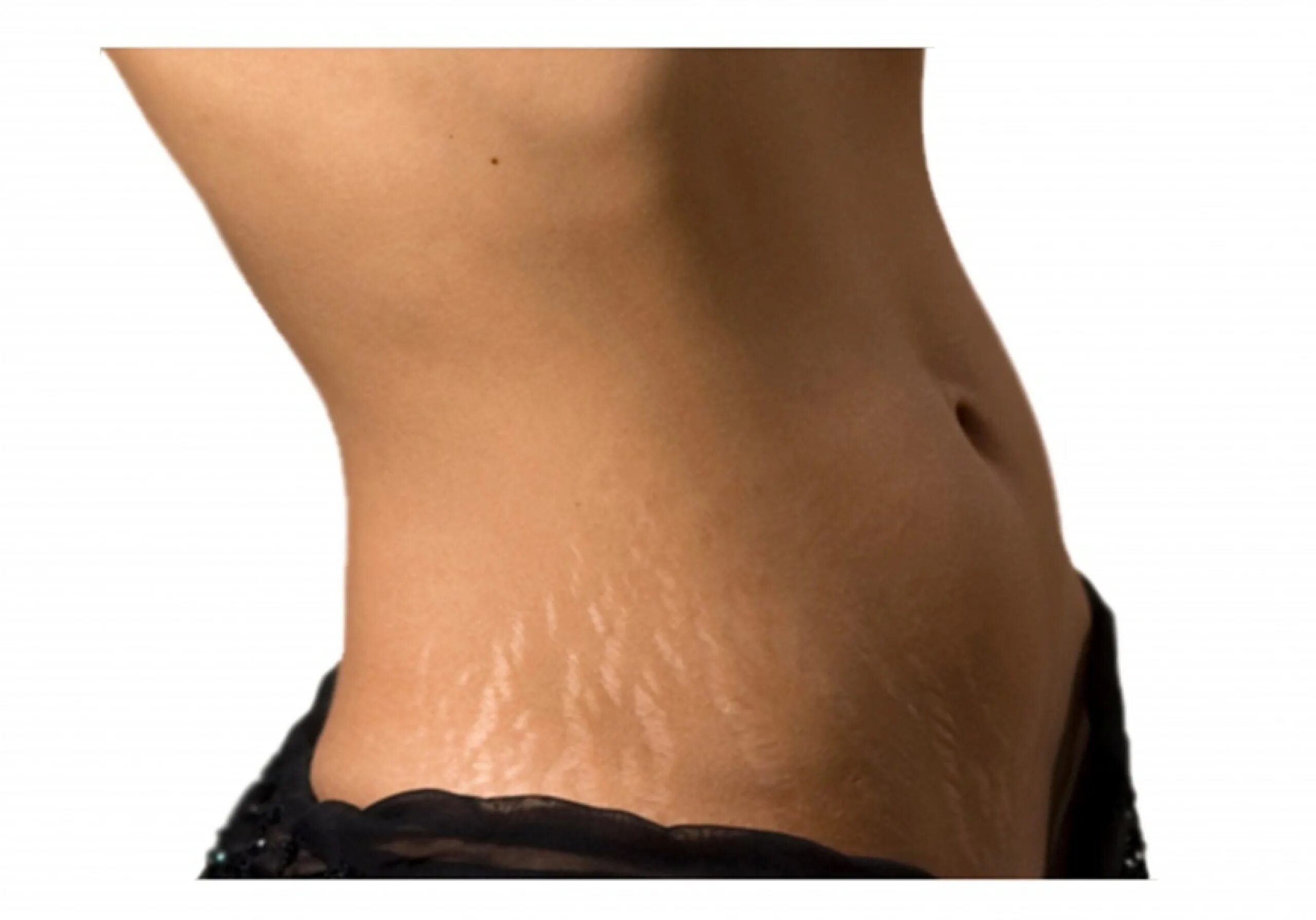 Что такое растяжки. Что такое растяжки. Что такое растяжки. Беременный живот с растяжками. Что такое растяжки.