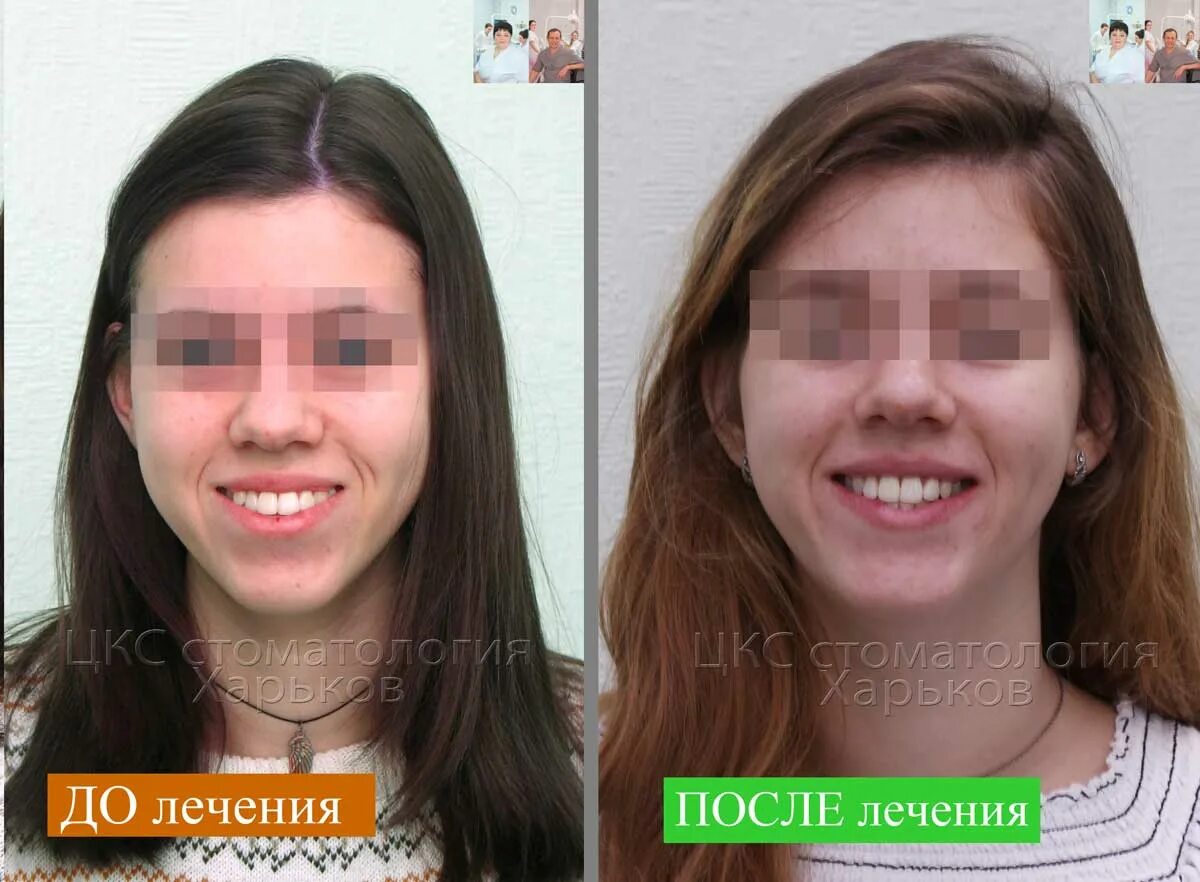 Лицо до после удаления мудрости. Изменение лица после брекетов. брекеты до и после до и после лицо. овал лица после брекетов.
