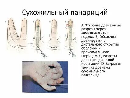 Рана пальцев кисти код