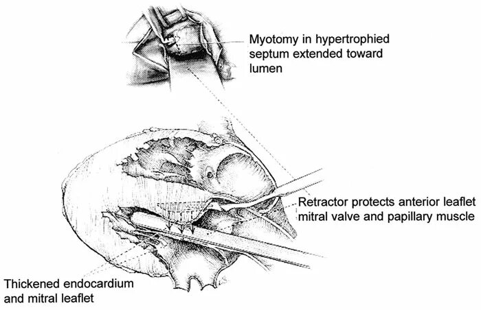 Миоэктомия. Миосептэктомия по Морроу операция. Чрезаортальная септальная миэктомия. Септальная миоэктомия по Морроу.