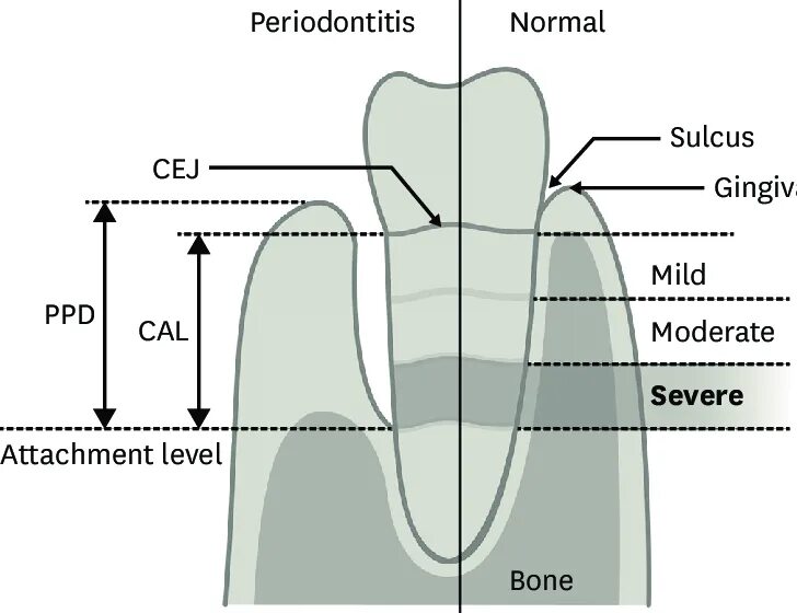 Attachment view. Clinical attachment loss. clinical attachment level.